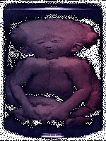 baby specimen in a jar